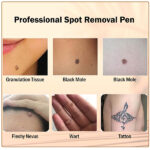 Mole Freckle Pen 1